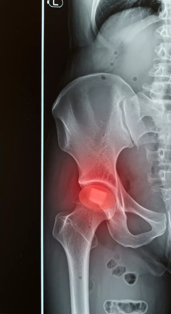 Know Your Rights After A Hip Injury